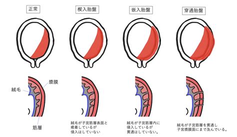 胎盤在前面